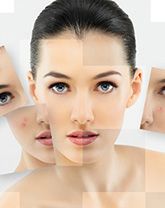 chemical peels after