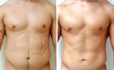 Lipoplasty