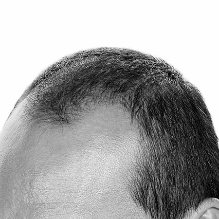 hairtransplantsurgery
