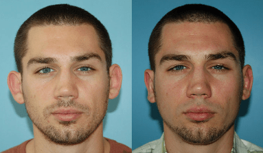 Otoplasty