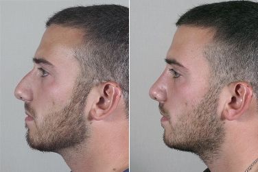 Rhinoplasty