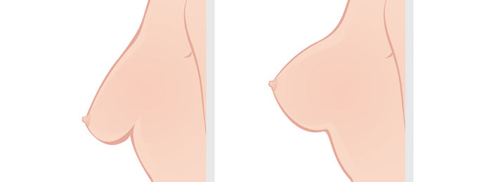 Breast Uplift Surgery