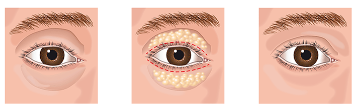 Eye bag removal surgery blepharoplasty surgery