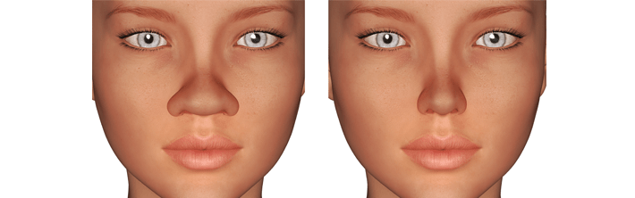 Rhinoplasty Nose Job London | Nose Job London UK | Nu Cosmetic Clinic
