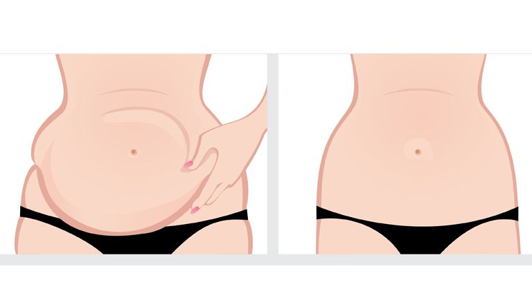 Tummy Tuck