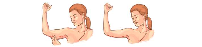 Brachioplasty | Brachioplasty UK | Nu Cosmetic Clinic