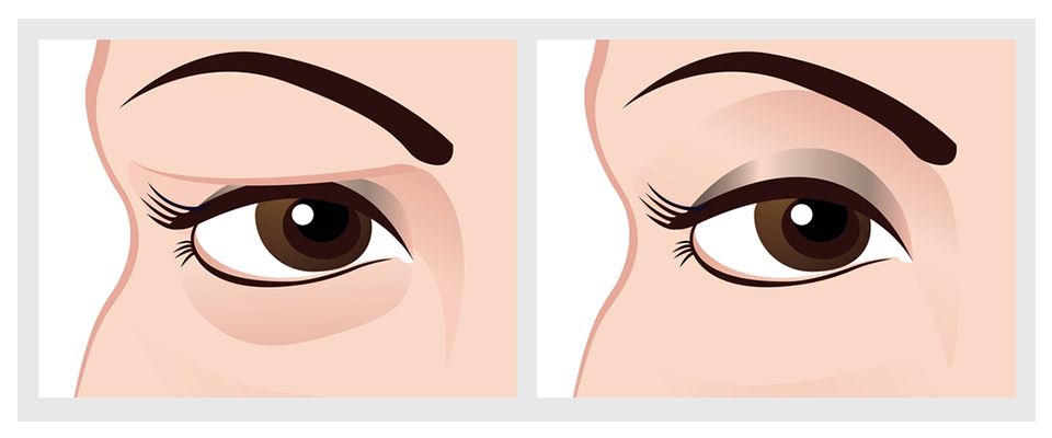 eyelid-surgery-blepharoplasty-uk