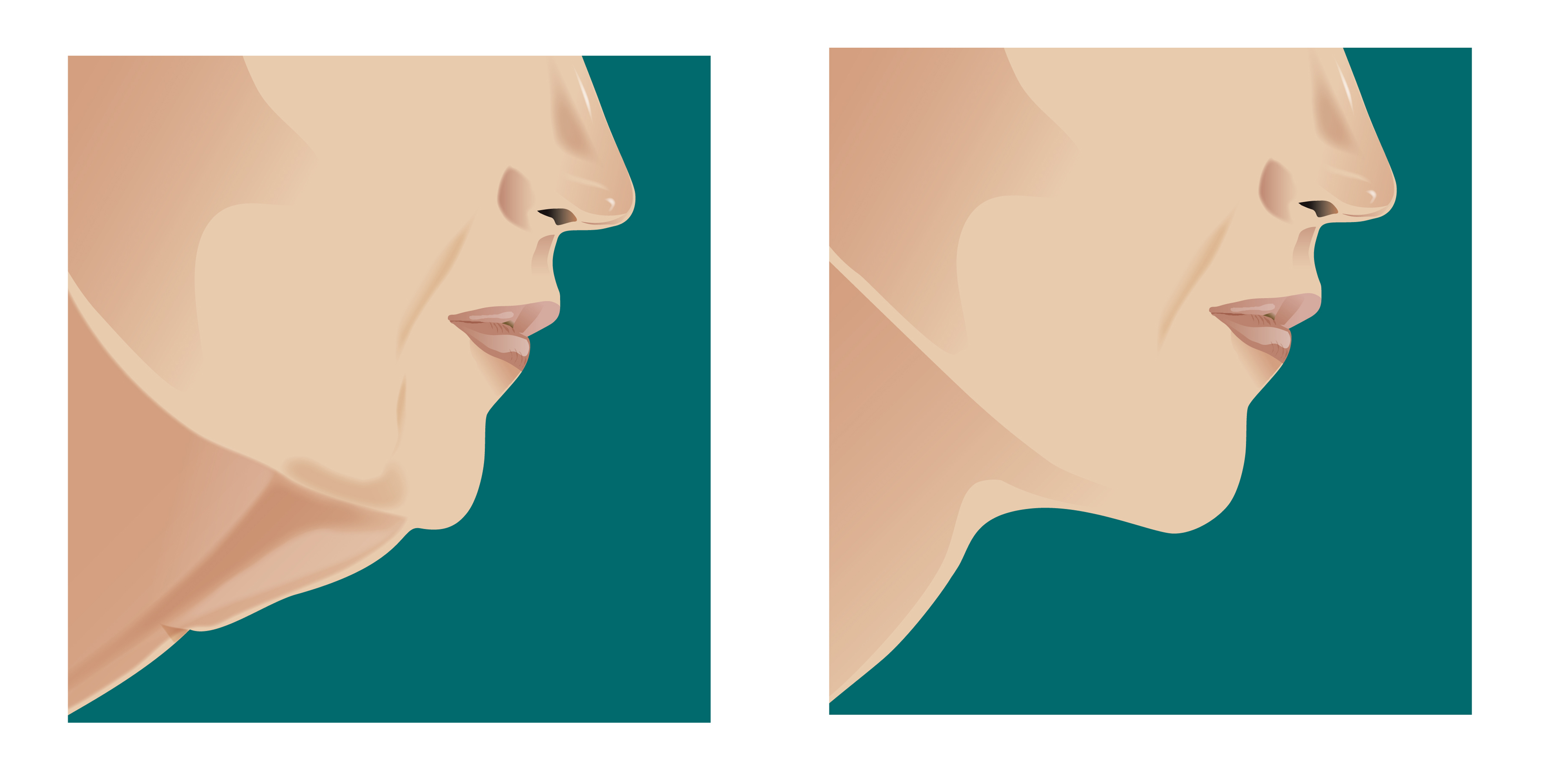 Facelift