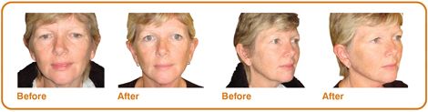facelifts-before_and_afters
