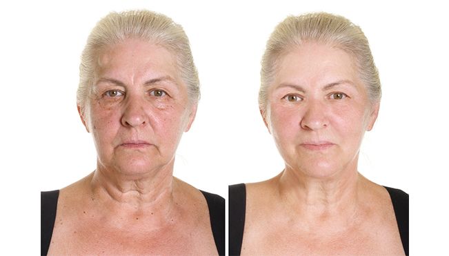 facial-implants