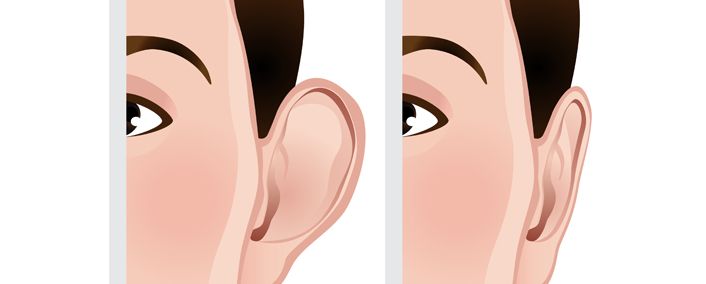 Otoplasty,Pin Back Ears | Pin Back Ears UK |Eear Correction Surgery - Nu Cosmetic Clinic
