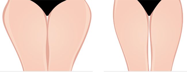 thigh lift surgery before & after