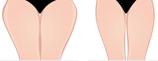 Thigh Lift