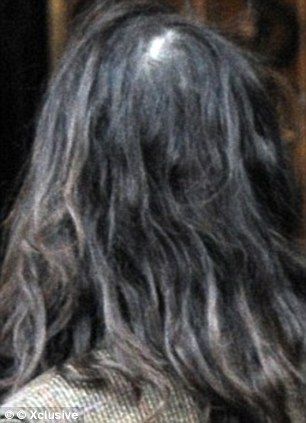 alopecia areata