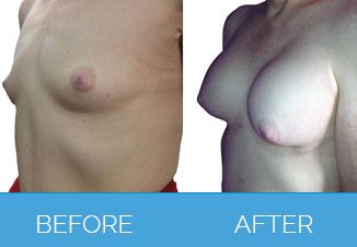 Breast Enlargement Surgery Beafore and After
