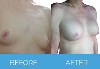 Breast Enlargement Surgery 1