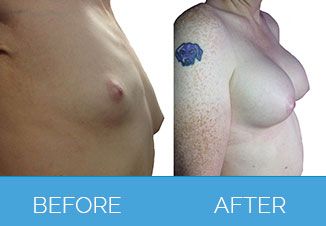 Breast Augmentation Beafore and After