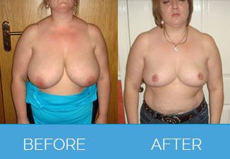 Breast Uplift Procedure Before and After