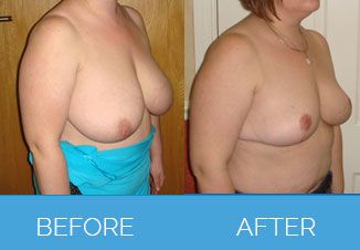 Breast-Reduction2