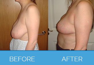 Breast-Reduction3