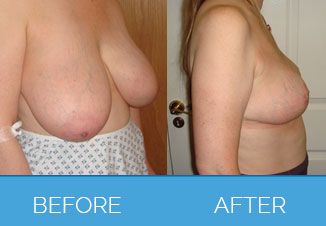 Breast-Reduction4
