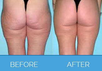 Buttock Lift Surgery Before and After