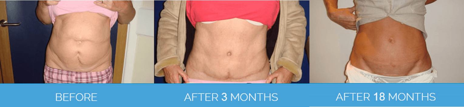 Tummy Tucks Before And After | Tummy Tucks Before And After UK | Nu Cosmetic Clinic