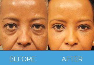 facial implants1