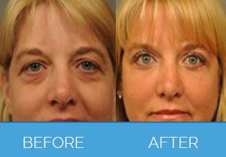 facial implants12