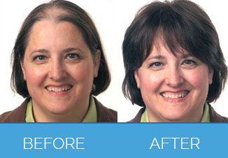 Before and After Female Hair Transplant2
