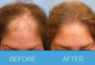 Before and After Female Hair Transplant1