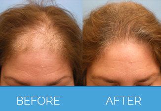Hair-Transplant2