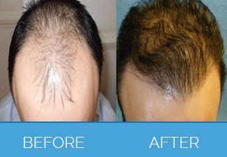 Hair-Transplant-Surgery-Leeds