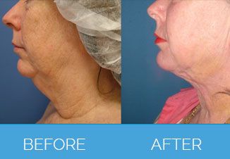 Liposculpture2
