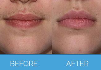 Laser Hair Removal