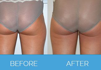 Laser Lipolysis - Before and After Back Side