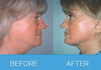 Laser-Lipolysis-Before-After Lipo With Laser  | Lipo With Laser  UK | Nu Cosmetic Clinic