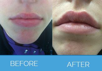 Before and After - Lip Fillers