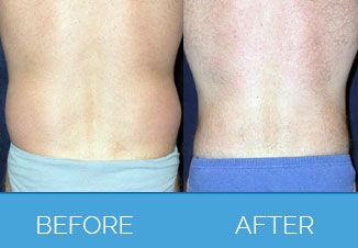 Liposculpture | Liposculpture | Liposculpt | Liposculpting - Nu Cosmetic Clinic