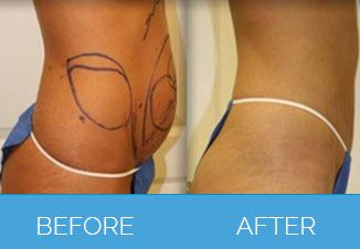 Liposuction before after 2