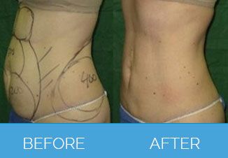 liposuction before after 1