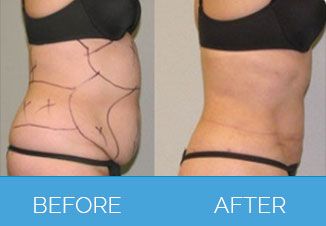 Liposuction before after