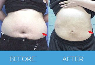 Liposuction before after 3
