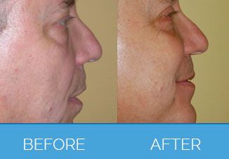 Male Facelifts | Rhytidectomy