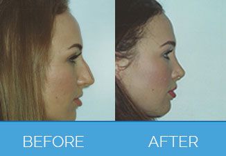 Nose Correction1