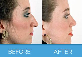 Nose Correction Surgery4