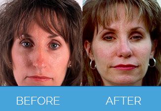 Nose Correction Surgery5