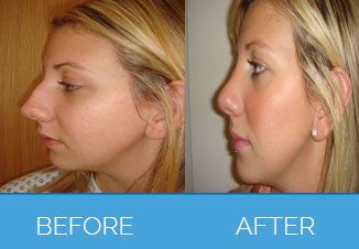 Nose Correction Surgery10