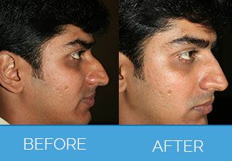 Non Surgical Nose Reshaping