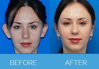 Otoplasty